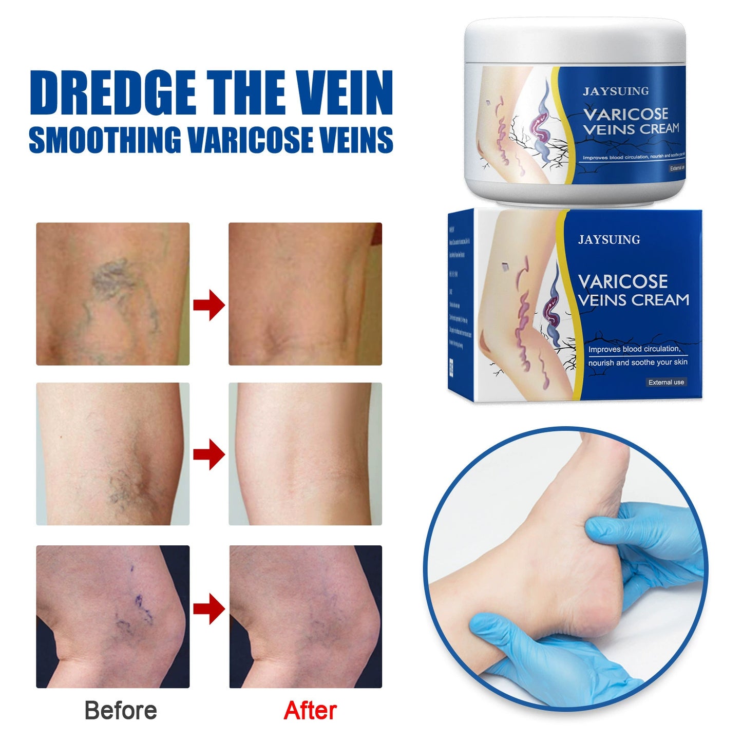 Leg Relief Varicose Veins Cream for Pain and Swelling Body Care Lotions Comfort Skin Care- CU